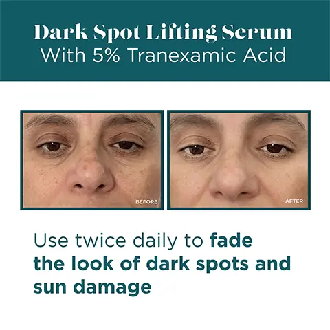 Image 1, Dark spot lifting serum with 5% tranexamic acid showing before and after model shot. To be used twice daily to fade the look of dark spots and sun damage. Image 2, key ingredients powerhouse blend. 5% tranexamic acid that improves the look of existing dark spots and sun damage, kojic acid that helps prevent the appearance of future dark spots and lactic acid that gently exfoliates and resurfaces skin. Image 3, in just 90 days- 86% saw significant results, 86% saw brighter skin and 79% saw a reduction in dark spots. Image 4, improves the look of existing dark spots and sun damage, helps prevent the appearance of future dark spots and brightens overall skin tone. Image 5,Dark spot lifting serum with 5% tranexamic acid 5 star review: 'it broken up my dark spot clusters, brightened up my skin and made my skin look immediately glowy