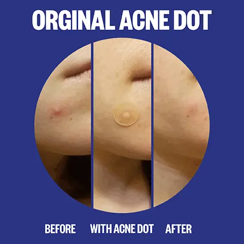 Image 1, original acne dot, before, with acne dot, after.  Image 2, your day and night acne solutions. daytime = start with clean, dry skin and apply a day dot directly on your blemish. follow with AM skincare and makeup (or not). Nighttime, for peskier pimples, apply original acne healing fots on clean, dry skin before your PM skincare routine. Image 3, acne day dot is invisible when worn along or under makeup. original acne healing dot, heavy hitter for peskier breakouts overnight. Image 4, the ingredients, hydrocolloid polymer technology = extracts impurities while guarding against external elements. encapsulated salicylic acid penetrates pores to target blemishes and blackheads. retinol = helps promot clear-looking skin. aloe vera leaf extract = soothes while minimizing the appearance of redness. conceal wile you heal.