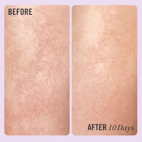 Image 1, skin before and after 10 days of use. Image 2, skin before and after 6 uses. Images show reduced bumps for smoother skin