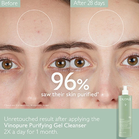 Image 1 - Image shows a side-by-side comparison of a persons face before and after using the Vinopure Purifying Gel Cleanser for 28 days, with clear improvement in skin clarity; visible text includes Before and After 28 days, 96% saw their skin purified*, and Unretouched result after applying the Vinopure Purifying Gel Cleanser 2X a day for 1 month alongside an image of the cleanser bottle.
              Image 2 - A person with long hair is shown applying a green bottle of skincare product to their shoulder, with text on the side stating 96% saw their skin purified and the phrase Face, neck and back.
              Image 3 - A green bottle of Caudalie Vinopure purifying gel cleanser is surrounded by rose petals, green leaves, and berries, with visible text stating Natural salicylic acid, Visibly unclogs pores & refines skin texture, Polyphenols, and Antioxidant.
              Image 4 - Before and after comparison of a persons jawline showing clear skin improvement, with the left side labeled Before and the right side labeled After 28 days, accompanied by a product bottle labeled CAUDALIE Vinopure Purifying Gel Cleanser and the text 96% saw their skin purified* Unretouched result after applying the Vinopure Purifying Gel Cleanser 2X a day for 1 month.
              Image 5 - Two bottles of Caudalie Vinopure skincare products are shown against a light background, one large size at 385mL and one retail size at 150mL, both surrounded by foamy bubbles; visible text reads Large size 385mL, Retail size 150mL, and CAUDALIE.
              Image 6 - Image shows two facial cleansers: on the left is the Vinoclean Foaming Cleanser in a bottle with a foam texture, labeled for all skin types; on the right is the Vinopure Gel Cleanser in a bottle with a gel texture, labeled to cleanse and reduce blemishes for acne-prone skin, with a VS in the center between them.
              Image 7 - An image showing a bottle of Caudalie Purifying Gel Cleanser with instructions on how to recycle it, stating How to recycle the Purifying Gel Cleanser with steps: 1 Dispose of bottle in recycling bin* 2 Recycle pump with TerraCycle and a note about multi-material pumps being recyclable in specific locations.
              Image 8 - Image shows a set of green skincare products arranged creatively, labeled with numbers and descriptions: 1. CLEANSE - Purifying Gel Cleanser, 2. PURIFY - Purifying Toner, 3. CORRECT - Blemish Control Salicylic Serum, 4. MATTIFY - Moisturizing Mattifying Fluid, 5. TARGET - Salicylic Spot Solution.