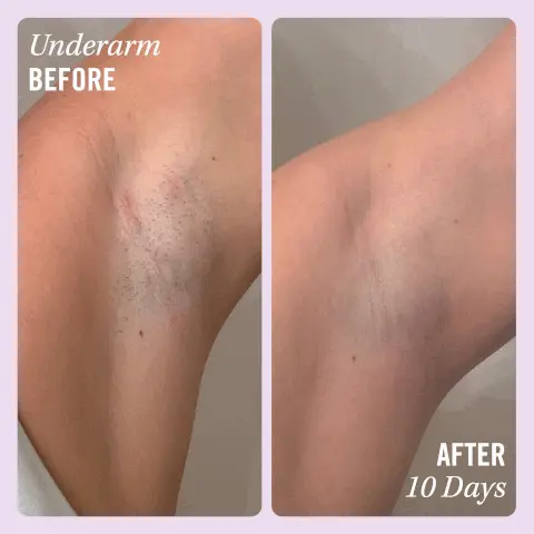 Image 1, underarm before vs results after 10 days. Image 2, Bikini line before vs results after 10 days