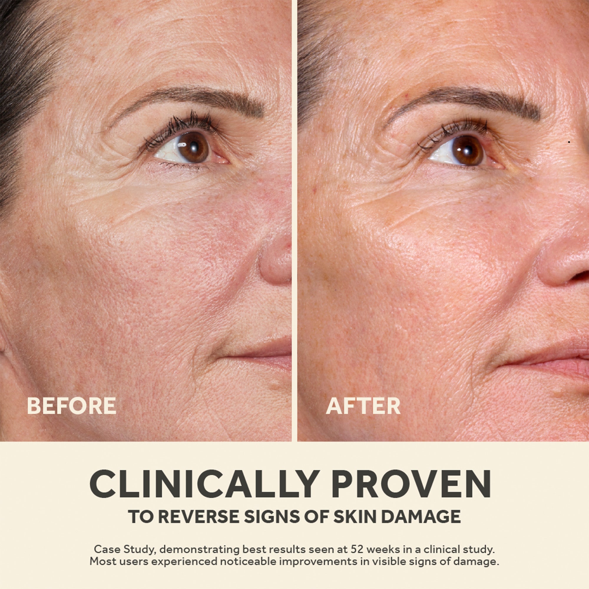 Before-and-after close-up showing smoother skin texture and reduced fine lines after 52 weeks of use.
