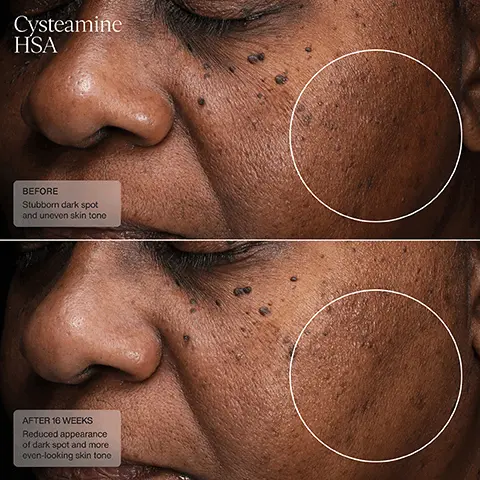 Cysteamine HSA, Before, Stubborn dark spot and uneven skin tone. After 16 weeks, Reduced appearance of dark spot and more even-looking skin tone. Dermal Repair Cream, Before, Facial redness, After 2 weeks, Reduced facial redness. Dermal Repair Cream, Before, Fine lines, After 2 weeks, Fine lines. Dermal Repair Cream, Before, Uneven skin tone, After 2 weeks, More even looking skin tone. Dermal Repair Cream, Before, Facial redness, After 4 weeks, Reduced facial redness.