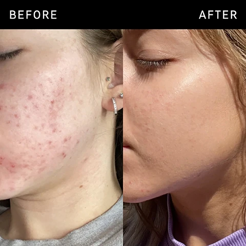 Image 1 - Image shows a side-by-side comparison of a persons face with acne on the left labeled BEFORE and the same persons face with clearer skin on the right labeled AFTER.
              Image 2 - A white cosmetic serum bottle with a black pump labeled The Inkey List Niacinamide Serum, accompanied by text that outlines its benefits: targets excess oil and helps to even skin tone, soothes skin and visibly reduces redness, improves appearance of blemishes and blackheads.
              Image 3 - A close-up image of a white skincare product with the following text: Ingredients, 10% Niacinamide, Helps to reduce the appearance of excess oil, blemishes, and redness, Hyaluronic Acid, Helps to hydrate and soothe the skin.
              Image 4 - A woman gently applying a skincare product on her cheek is shown on the left side, while the right side contains text that reads: FAQ CAN I LAYER IT WITH OTHER ACTIVE INGREDIENTS? Yes, but be careful if using with high percentage Vitamin C products or exfoliating acids like Glycolic Acid. It is safe to use with our Vitamin C 15% and EGF Serum. CAN I USE NIACINAMIDE SERUM WITH RETINOL SERUM? Yes, using Niacinamide Serum with Retinol Serum can help to decrease visible signs of irritation, such as redness.
              Image 5 - An illustration of a white cream or lotion drop on a light background, with the text How to layer your routine at the top and numbered steps 1 to 5 below, indicating Clean, Hydrate, Treat, Moisturize, and SPF.
              Image 6 - A woman with braided hair holds a bottle of niacinamide serum near her face, with visible text stating When to apply followed by icons for AM and PM.