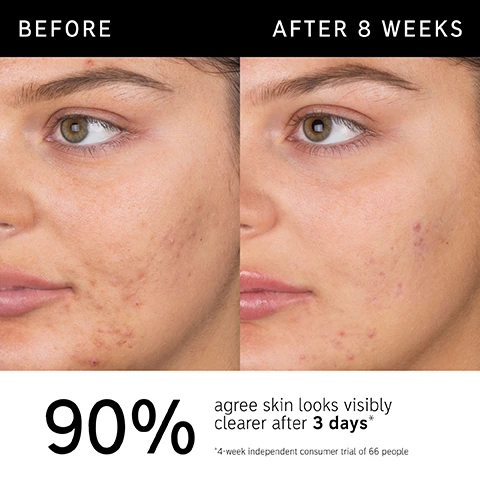 Image 1 - Image shows a close-up of a womans face split into two halves; the left side labeled Before shows visible skin blemishes and imperfections, while the right side labeled After 8 Weeks displays clearer skin; the lower part of the image includes the text 90% agree skin looks visibly clearer after 3 days and a note about a 4-week independent consumer trial of 66 people.
              Image 2 - A bottle of salicylic acid cleanser from The Inkey List is shown with bubbles around it, and the text beside it states that it is clinically proven to visibly reduce acne blemishes and blackheads, helps minimize excess oil, and is non-drying, non-stripping, and non-irritating.
              Image 3 - A smiling young woman with braided hair on the left side is partially visible, while the text on the right lists percentages: 90% agree skin looks visibly clearer after 3 days, 93% agree skin instantly looks and feels less oily, 92% agree skin did not feel tight or stripped, with a note about a consumer trial of 66 people.
              Image 4 - Image shows a close-up view of a clear, bubbly liquid with text overlaid that reads: Ingredients 2% SALICYLIC ACID Works deep within pores to help unclog and gently exfoliate 0.5% ALLANTOIN Helps soothe and comfort skin ZINC COMPOUND Helps reduce excess oil.
              Image 5 - A close-up image of a young person washing their face, with text that reads FAQ, CAN I USE THIS DAILY? Yes, for best results use AM and PM daily. For sensitive, blemish-prone, or dehydrated skin, use 2 - 3 times per week. CAN I USE ON MY BODY? Yes, you can use Salicylic Acid Cleanser on other blemish-prone areas, including the back and chest.
              Image 6 - An abstract droplet of clear liquid is shown on a light background, with the text How to layer your routine above and numbered steps 1 to 5 labeled as Clean, Hydrate, Treat, Moisturize, and SPF below.
              Image 7 - A hand holding a bottle of salicylic acid cleanser with a plain white background, alongside icons representing morning and night application with the text When to apply AM PM.