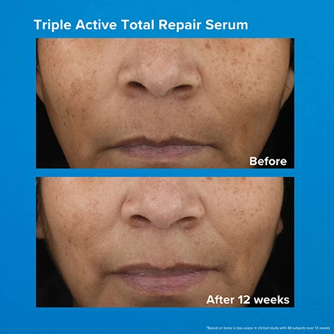Image 1, triple active total repair serum, before and after 12 weeks. based on twice a day use in a clinical study with 48 subjects over 12 weeks. image 2, triple active total repair serum - normal, dry oily, combo, acne-prone. what it targets = fine lines and wrinkles, discoloration, loss of firmness, uneven tone, dullness.
