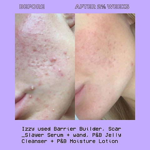 before and after 2 and half weeks. Izzy used barrier builder scar slayer serum and wand, p and b jelly cleanser and p and b moisture lotion