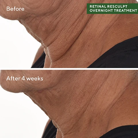 image 1, Before and after 4 weeks wrinkles appear reduced. image 2, in 2 weeks = visibly lifts neck/jowl sagging. visibly smooths deep-set wrinkles and crepey skin. based in a 4 week clinical study with 47 partipants, ranging for fitzpatrick types 1-6. image 3, what's your retin-type A or O? retinal, type A = corrective. retinol, type O = preventative. image 4, murad ingredients plus. olive, oat and alpha glucan support resilience and boost moisture. kangaroo paw flower = helps improve the look of sagging skin. encapsulated retinal = for advanced signs of aging neck/jowl agging, crepey skin and deep set wrinkles. image 5, dramatically lift and firm. serious results of retinoids without a doctor's visit. 1 = renewing cleansing cream - cleanse and pat dry. 2 = retinal resulpt overnight treatment - apply a thin layer of the treatment to face and neck. 3 = retinol youth renewal night cream - at night massage night cream evenly over face, neck and chest. 4 = targeted wrinkle corrector - tap into wrinkle with the metal side, if needed use ring finger to tap into wrinkles, let dry.