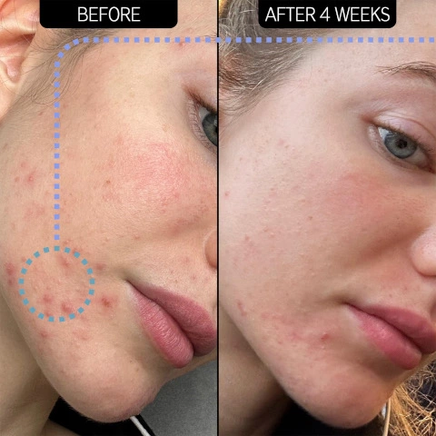 before and after 4 weeks to show clearer, smoother looking skin