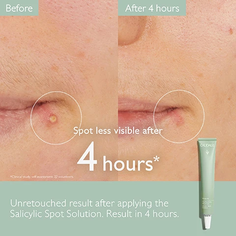 Image 1 - Side-by-side comparison of a persons skin showing a blemish before and after 4 hours of treatment with the Salicylic Spot Solution, with the text Spot less visible after 4 hours* and Unretouched result after applying the Salicylic Spot Solution. Result in 4 hours.
              Image 2 - A woman with dark hair and a lightly freckled face holds a green tube of Caudalie spot treatment near her cheek, which has some spots treated with the product, while text on the right states, dries out and reduces redness, spots less visible after 4 hours.
              Image 3 - A green tube of Caudalies acne treatment stands upright on a light green background, accompanied by three small green and red berries, with text indicating Natural salicylic acid: Unclogs pores and refines skin texture, Niacinamide: Tightens pores, and Tea tree essential oil: Purifies the spot.
              Image 4 - Image comparing two skincare products: on the left, a green bottle of Blemish Control Salicylic Serum with text stating Corrects the appearance of blemishes, Reduces the appearance of blemishes, and Fluid gel texture, while on the right, a green tube of Salicylic Spot Solution with text stating Targets specific spots, Reduces redness, and Cream texture.
              Image 5 - Image shows a mint green background with a partially used tube of Caudalies Salicylic Spot Solution and a white cap next to it, with instructions on how to recycle, stating to dispose of the tube in a recycling bin and to recycle the cap with TerraCycle, accompanied by a note about multi-material pumps.
              Image 6 - Image shows five skincare products from Caudalie arranged on a light green background with accompanying text labeling each product: 1. Cleanse Purifying Gel Cleanser, 2. Purify Purifying Toner, 3. Correct Blemish Control Salicylic Serum, 4. Mattify Moisturizing Mattifying Fluid, and 5. Target Salicylic Spot Solution.