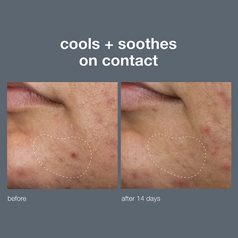 image 1, cools and soothes on contact. before and after 14 days. image 2, 5% collodioal sulfure - helps combat breakouts for rapid skin clearing. skin mimicking film - forms a breathable patch for airflow and protection. 4% niacinamid - helps soothe skin and fade post breakout marks.