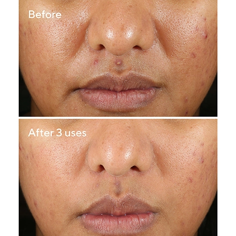 Before and after 3 uses showing skin more visibly clear.