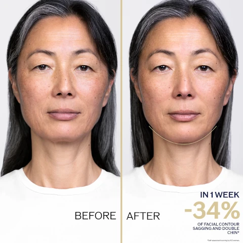 before and after. in one week -34% of facial contour sagging and double chin. self assessment scoring by 102 women