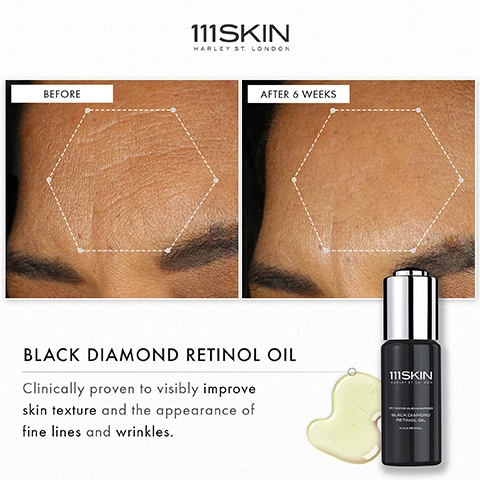 111 Skin Harley ST. London. Before and after 6 weeks. Black Diamond Retinol Oil. Clinically proven to visibly improve skin texture and the appearance of fine lines and wrinkles.