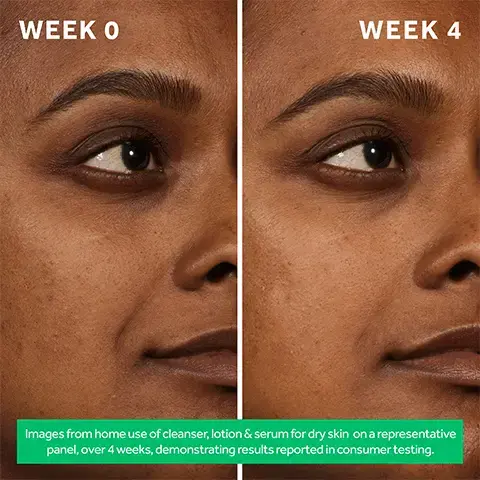 week 0, week 4. Images from home use of cleanser, lotion, serum for oily skin and the clearing treatment on a representative panel, over 4 weeks, demonstrating results reported in consumer testing.