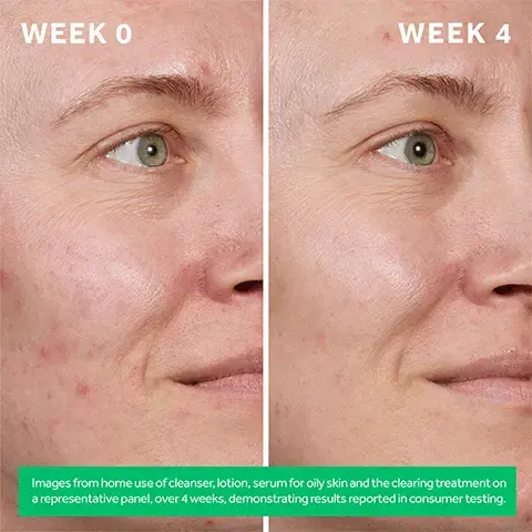 week 0, week 4. Images from home use of cleanser, lotion, serum for oily skin and the clearing treatment on a representative panel, over 4 weeks, demonstrating results reported in consumer testing.