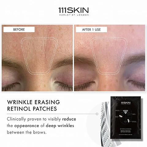 Image 1 - Image shows a before and after comparison of a forehead area with visible wrinkles, with labeled sections BEFORE and AFTER 1 USE, and includes product description WRINKLE ERASING RETINOL PATCHES Clinically proven to visibly reduce the appearance of deep wrinkles between the brows.
              Image 2 - Image shows two side-by-side close-up photos of an eye area with wrinkles, labeled Before on the left and After 1 Use on the right, with dotted lines indicating the treatment area; text at the bottom reads WRINKLE ERASING RETINOL PATCHES Clinically proven to visibly reduce the appearance of deep wrinkles between the brows.
              Image 3 - Before and after images of a persons eye area showing reduced wrinkles, with visible text stating WRINKLE ERASING RETINOL PATCHES and Clinically proven to visibly reduce the appearance of deep wrinkles between the brows.