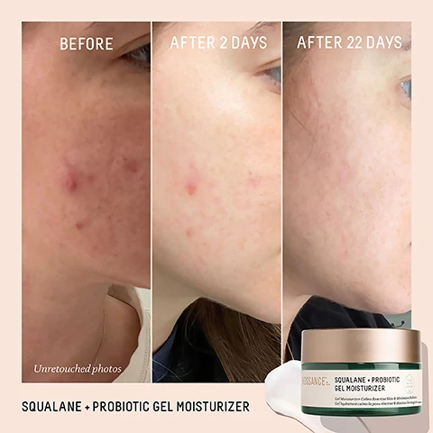 Image 1, before, after 2 days and after 22 days. unretouched photos. image 2, before and after 14 days. image 3, after 1 use - 100% agree their skin looks calm and less irritated. 94% showed improvement in pore size. after 1 week - 94% agree redness was visibly improved. after 4 weeks - 97% agree their skin looks clearer. based on a 4 week consumer study of 33 women aged 18-50. based on a 4 week clinical study of 33 women aged 18-50. image 4, what is your skin microbiome? your skin's microbiome is a home to trillions of bacteria that fortify, protect and nourish skin. how do probiotics support your microbiome? when there are too many bad bacteria, probiotics restore balance by delivering a plethora of healthy bacteria to your microbiome. what are the benefits? a balanced microbiome results in less irritation, redness and excess oil for an overall healthy, clear complexion. image 5, find your moisture match. probiotic gel moisturiser - the redness reducer = skin type is oily to combination. texture = lightweight gel. results = calms and soothes while balancing the microbiome. vitamin c rose moisturiser - the instant brightener. skin type = normal to dry. texture = cushion cream. results = brightens complexion and fights free radicals. omega repair cream - the heavy duty hydrator. skin type = dry to mature. texture = rich cream. results = repairs the skin barrier and plumps fine lines and wrinkles. image 6, breakout-prone skin routine. step 1 = deeply cleanse with amino acid gentle cleanser. step 2 = BHA pore minimizing toner balances and clarifies. step 3 = 10% lactic acid resurfacing serum improves texture. step 4 = probiotic gel moisturiser calms and hydrated.