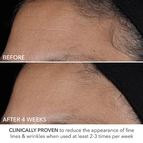 Image 1, BEFORE AFTER 4 WEEKS CLINICALLY PROVEN to reduce the appearance of fine lines & wrinkles when used at least 2-3 times per week Image 2, BEFORE AFTER 4 WEEKS CLINICALLY PROVEN to visibly improve texture and the appearance of pores when used at least 2-3 times per week Image 3, THE POWER OF PURE RETINOL • Reduce fine lines & wrinkles Even tone & texture • Clears congestion • Boost radiance Image 4, PURE 0.5% RETINOL: smooths lines & wrinkles BAKUCHIOL & RAMBUTAN amplifies anti-aging & firming benefits of retinol B Dr Dennis Gross Advanced Resol Perfectly Dosed Retinol 0.5% Pure Retinol SQUALANE & HYALURONIC ACID soothe, hydrate & lock in moisture FERULIC ACID: helps counteract the irritating effects of retinol Image 5, BOOST YOUR DAILY RETINOL ROUTINE Use up to 4 times per week as skin tolerates Image 6, Dr Dennis Gross Universal Daily Posl Forme this Tom/T D Dr Dennis Gross Advanced Retinol + Ferulic Perfectly Dosed Retinol Extra Strength 0.5% Pure Retinol Dr Dennis Gross versal Daily Pel POWERFUL TREATMENTS AM Alpha BetaR Daily Peel ( PM Perfectly Dosed Retinol Image 7, CLINICAL PROOF 97% had immediate reduction in fine lines 100% had reduced dryness immediately 93% said the product was gentle and non-drying 87% had had firmer skin after 1 use