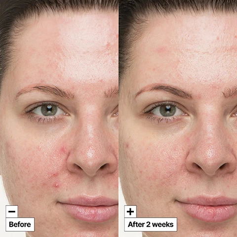 Image 1, before and after 2 weeks. image 2, centella asiatica extracts highest concentration for super intensive soothing. fensibiome peptide strengthens skins barrier. alpaflor strengthens skins barrier. image 3, suitable for post-treatment skin. shown to be safe for use following glycolic acid peel treatment or intense pulsed light LIPL treatment in 2 weeks clinical usage tests. image 4, AM and PM routine for SOS days. 1 = cleanse with foam cleanser. 2 = prep with treatment lotion. 3 = treatment S.O.Soothing treatment. 4 = colour correcting treatment