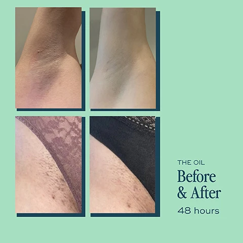 Image 1, the oil before and after 48 hours. image 2, multi-tasking oil for ingrown hairs, razor rash, redness, bumps and more. for all skin even intimate. image 3, after 2 weeks 92% dry skin visibly improved. 85% reduced irritation caused by hair removal, 83% reduced redness, 81% reduced appearance of bumps. clinical user trial, 102 women of all ages, stages and skin types. image 4, customer review - one oil to rule them all. this is incredible, been using on my pubic skin and underarms as i always get ingrowns and red bumps after shaving. after literally a few uses (and the tiniest amount needed as a little goes a long way) i have no redness and two ingrowns in my groin have disappeared don't hesitate. image 5, travel size on the go. small but mighty, 1 month supply. image 6, how to recycle - separate cap from pipette, rinse bottle, recycle cap, bottle and tube.