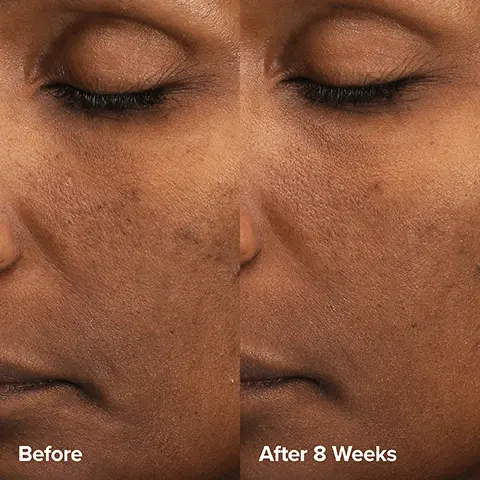 Before and after 8 weeks Image 2, ﻿ EXFOLIATE PAULA'S CHOICE SKIN PERFECTING 6% Mandelic Acid + 2% Lactic Acid Liquid Exfoliant TIME-RELEASED 8% AHA MULTI-LAYER COMPLEX All Skin Types IMPROVES SUN DAMAGE. DULLNESS & FINE I INE LINES REVERSES A COMPROMISE SKIN BARRIER 30 ml/1 fl. oz. 6% Mandelic + 2% Lactic Acid AHA Liquid Exfoliant + Resurfaces texture & tone + Works above skin's surface PAULA'S CHOICE SKIN PERFECTING 2% BHA Liquid Exfoliant SALICYLIC ACID All Skin Types UNCLOGS & SHRINKS ENLARGED PORES SMOOTHS & EVENS SKIN TONE 30 ml / 1 fl. oz. 2% BHA Liquid Exfoliant + Unclogs pores + Works below skin's surface PAULA'S CHOICE PAULA'S CHOICE SKIN PERFECTING 6% Mandelic Acid + 2% Lactic Acid Liquid Exfoliant TIME-RELEASED 8% AHA MULTI-LAYER COMPLEX All Skin Types IMPROVES SUN DAMAGE. DULLNESS & FINE LINES REVERSES A COMPROMISED SKIN BARRIER 30 ml/1 fl. oz. EXFOLIATE SKIN PERFECTING 2% BHA Liquid Exfoliant SALICYLIC ACID All Skin Types UNCLOGS & SHRINKS ENLARGED PORES SMOOTHS & EVENS SKIN TONE 30 ml/1 fl. oz. AHA + BHA Use together for multi-level glow from the #1 exfoliation experts Make It a Routine + Beginner: Start with AHA every 2-3 days & BHA every 2-3 days + Moderate: Alternate AHA & BHA every other day + Advanced: Use AHA & BHA daily- one in the AM and the other in PM Image 3, ﻿ Clinically Proven Results 100% had smoother, softer, brighter skin *Based on self-assessment from an independent clinical trial with 30 subjects after 3 weeks. Image 4, ﻿ FROM THE #1 EXFOLIATION EXPERTS AT SEPHORA 6% Mandelic Acid + 2% Lactic Acid AHA Liquid Exfoliant + Resurface skin without irritation + Visibly improves sun damage, dullness & lines + For all skin types & tones Image 5, ﻿ KEY INGREDIENTS 6% Mandelic Acid + Gentlest form of AHA + Targets wrinkles & discoloration 2% Lactic Acid + Time-released AHA for extended results + Hydrates & smooths skin's surface Yarrow Root Extract & Cherry Blossom + Support skin's moisture barrier & microbiome + Soothing antioxidant Image 6, ﻿ EXFOLIANT STEP 3: EXFOLIATE Resurface & Renew HOW TO APPLY Apply with your hands or a cotton pad, gently pat on face & neck. WHEN TO APPLY At first, apply once every other day and note skin's response. Then, use up to twice daily. For the AM, always finish with SPF 30+.
