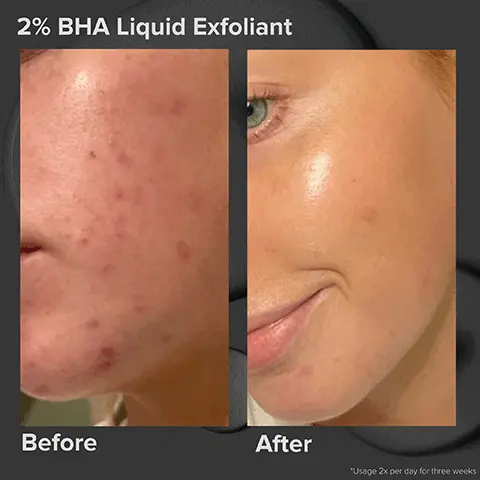 2% BHA Liquid Exfoliant. Before and After. 6% Mandelic Acid +2% Lactic Acid Liquid Exfoliant. Before and After 8 weeks.