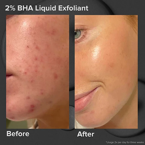 Image 1, before and after 2% BHA liquid exfoliant. usage 2 times per day for three weeks. image 2, 6% mandelic acid + 2% lactic acid liquid exfoliant. before and after 8 weeks. image 3, 6% mandelic + 2% lactic acid AHA liquid exfoliant = resurfaces texture and tone, works above skin's surface. 2% BHA liquid exfoliant = unclogs pores, works below skin's surface.