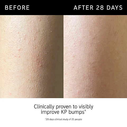 Image 1 - Image shows a side-by-side comparison of a persons chest before and after using a skincare product, with noticeable reduction in body breakouts in the after image; visible text includes BEFORE, AFTER 7 DAYS, and Visibly reduce body breakouts in 7 days*.
              Image 2 - Image showing a side-by-side comparison of skin before and after using a product for 28 days, with the left side displaying rough, textured skin and the right side showing smooth skin, accompanied by the text Clinically proven to visibly improve KP bumps* *28 days clinical study of 21 people.
              Image 3 - Image of a stick of exfoliating body cream labeled GLYCOLIC ACID EXFOLIATING BODY STICK, with text that reads: Multiple concerns. One targeted solution. Proven to tackle KP bumps, ingrown hairs and breakouts. Powered by chemical exfoliation for your healthiest-looking body skin. *4-week consumer study of 100 people.
              Image 4 - A person is applying a skincare stick to their arm, with three text sections stating that after the first use, it visibly improves dry, rough, flaky skin; after 7 days, it visibly reduces ingrown hairs; and after 28 days, it visibly reduces underarm and bikini line discoloration.
              Image 5 - Image shows a close-up of a creamy texture with text listing ingredients: 7% Glycolic Acid exfoliates surface skin cells to smooth rough, bumpy skin and even tone, 0.5% Salicylic Acid helps to unclog oily pores to target breakout-prone skin, and 10% Shea Butter deeply nourishing helps to instantly soften and comfort.
              Image 6 - A woman with a neutral expression holds a skincare product while appearing in an image that features a FAQ section detailing the safety of glycolic acid for use on the bikini line and underarms, and its non-comedogenic properties, including the text FAQ IS GLYCOLIC ACID SAFE TO USE ON BIKINI LINE AND UNDERARM? Yes, it is suitable for up to 1x daily use on the bikini line and underarms. We recommend leaving at least 8 hours after hair removal to minimize potential irritation. IS IT NON-COMEDOGENIC? No, however we tested it on people with blemish-prone body skin, and it is proven to visibly reduce body breakouts and leave skin clearer. *Tested on all skin tones. 2-week consumer trial of 66 people.
              Image 7 - A person holding a cylindrical body stick labeled Glycolic Acid Exfoliating Body Stick next to their shoulder, with text overlay stating When to apply ON CONCERN AREAS 2-3X PER WEEK.
              Image 8 - Image of a promotional graphic featuring a body care product labeled Glycolic Acid Exfoliating Body Stick by The Inkey List, with the text Multiple Concerns One Targeted Solution above and a list below that includes Kp Bumps (Keratosis Pilaris), Body Breakouts, Ingrown Hairs, Dry, Flaky, Rough Skin, Discolouration/Dark Marks, Rough Elbows/Knees, and Dry, Hard, Cracked Heels.
              Image 9 - Image shows a hand holding a black and white body exfoliating stick with text above it stating Chemical Exfoliation = your healthiest-looking body skin followed by four bullet points: Increases shedding of dead skin cells, Helps to unclog pores, Targets visible signs of congestion, and Smooths rough, bumpy texture.Image 10 - Image of two skincare products, one labeled PHA Exfoliating and Hydrating Body Water Cream and the other labeled Glycolic Acid Exfoliating Body Stick, with descriptive text about each products uses.