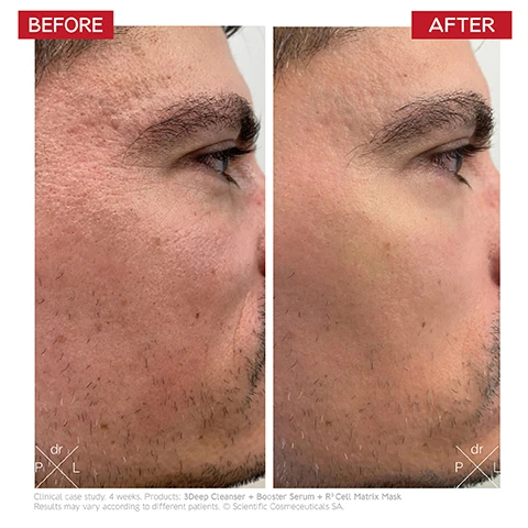 before and after. clinical case study. 4 weeks. products used = 3Deep cleanser, booster serum and R3 cell matrix max. results may vary according to different patients. scientific cosmeceuticals SA
