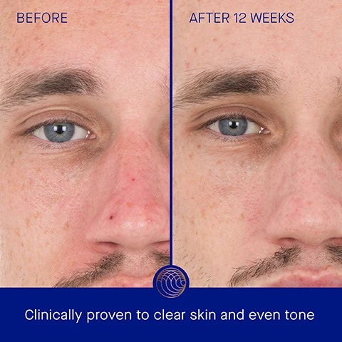 Image 1, before and after 12 weeks. clinically proven to clear skin and even tone. image 2, before and after 12 weeks. clinically proven to reduce the appearance of deep lines and wrinkles. image 3, clinically proven results. skin texture improved by 68%. the appearance of deep lines and wrinkles is reduced by 56%. post acne marks were visibly reduced by 90%. in a 12 week clinical trial of 64 males and females aged 25-70 with self perceived sensitive skin. image 4, user proven results. 97% agree the appearance of deep wrinkles and fine lines is reduced. 100% agree skin looks lifted, tighter and firmer. 98% agree skin looks and feels more smooth, clear and refined. in a 12 week consumer perception study of 103 males and females aged 25-70 with self perceived sensitive skin. image 5, step 1 = dispense desired amount into hands. step 2 = in upward sweeping motions, smooth over the face, neck and decollete. step 3 = follow by applying your augustinus bader skincare routine.