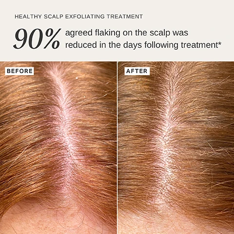 Image 1 - A split image displays a before and after comparison of a scalp with reddish-brown hair, showing significant flaking on the left and a much clearer, healthier appearance on the right, accompanied by the text HEALTHY SCALP EXFOLIATING TREATMENT 90% agreed flaking on the scalp was reduced in the days following treatment* BEFORE AFTER. Image 2 - A light green product bottle with a white pointed cap, with white liquid dripping down its sides and onto the light blue-green surface, features the visible text ALPHA-H HEALTHY SCALP EXFOLIATING TREATMENT WITH AUSTRALIAN DESERT LIME 100mL / 3.38 fl.oz. and descriptive text SALICYLIC ACID Gently and effectively exfoliates scalp skin, AUSTRALIAN DESERT LIME Rich in antioxidants and amino acids to promote healthy hair, RICE VINEGAR EXTRACT Helps to smooth hair and enhance shine.