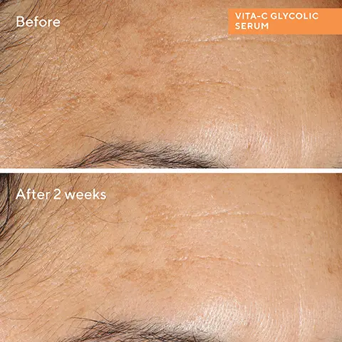 Before, After 2 weeks. VITA-C GLYCOLIC SERUM. 91% Saw brighter skin, smoother skin with more glow*. 94% Agreed skin feels softer and more hydrated. Proven results reported by trial participants, in a 2-week clinical study. Vitamin C Starter Kit. 01 CLEANSE Essential-C Cleanser. 02 TARGET Vita-C Glycolic Serum. 03 MOISTURISE + BRIGHTEN Essential-C Firming Radiance Day Cream.