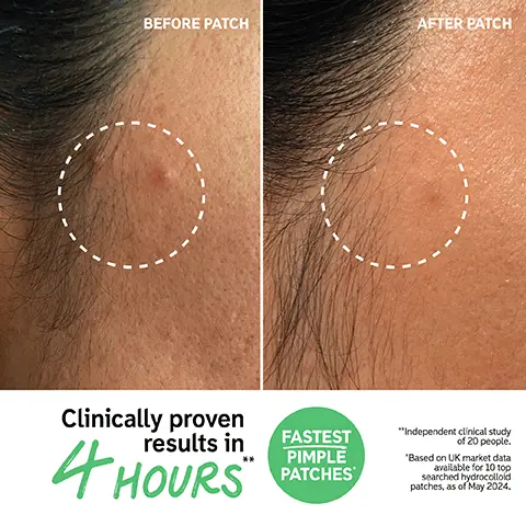 Before patch. After patch. Clinically proven results in 4 hours. Fastest pimple patches. Independent clinical study of 20 people. Based on UK market data available for 10 top searched hydrocolloid patches as of May 2024. How to layer in your routine. 1, Cleanse 2, Hydrocolloid Invisible Pimple Patches 3, Hyaluronic Acid Serum 4, Eye Treatment 5, Moisturize 6, SPF. How to use, 1, Prep 2, Patch 3, Results. Cover up and visibly reduce breakouts fast. INVISIBLURtm Technology. Ultra-thin & ultra-matte. Powerful, breakout-fighting ingredient blend. Undetectable. Fastest pimple patches. Clinically proven results in 4 hours based on US market data available for 10 top searched hydrocolloid patches, as of May 2024. Independent clinical study of 20 people.
