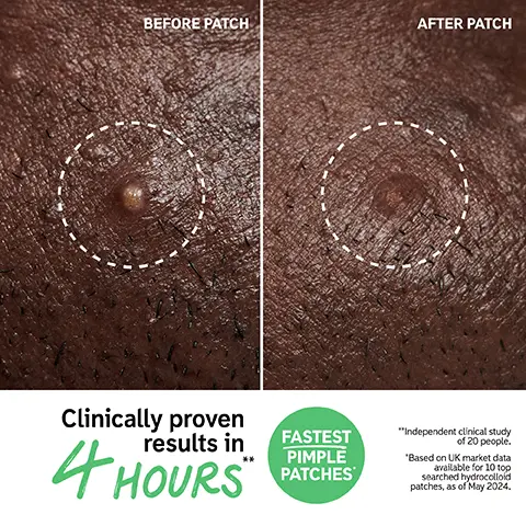 Image 1, BEFORE PATCH AFTER PATCH Clinically proven results in 4 HOURS FASTEST PIMPLE PATCHES "Independent clinical study of 20 people. 'Based on UK market data available for 10 top searched hydrocolloid patches, as of May 2024. Image 2, Clinically proven to visibly reduce breakouts in 4 HOURS "Independent clinical study of 19 people о Image 3, Hydrocolloid draws out gunk Salicylic Acid exfoliates to help unclog pores Succinic Acid helps absorb excess oil Ectoin helps lock in hydration Image 4, How to layer in your routine 1 Cleanse 2 Hydrocolloid Invisible Pimple Patches (3) Hyaluronic Acid Serum Eye Treatment 5 Moisturize 6 SPF
