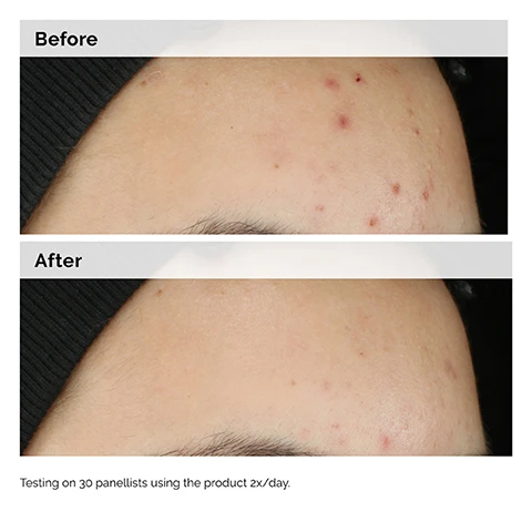 image 1 and 2, before and after testing on 30 panellists using the product twice a day. image 3, a multi active serum that targets skin congestion. image 4, formulated to reduce the reduce the look of: uneven texture, enlarged pores, excess oil. image 5, with 7 skin clearing technologies. meet balancing and clarifying serum. image 6, key ingredients in balancing and clarifying serum. N-acetylglucosamine (NAG) prevents pore congestion through surface level exfoliation. sarcosine and L-Carnitine = help reduce skin oiliness and sebum buildup in pores. adenosine = helps reduce the look of enlarged pores. image 7, multi active solution. balancing and clarifying serum = comprehensive formulations for multi benefit, includes 7 skincare technologies. can be used alone or combined with targeted solutions.