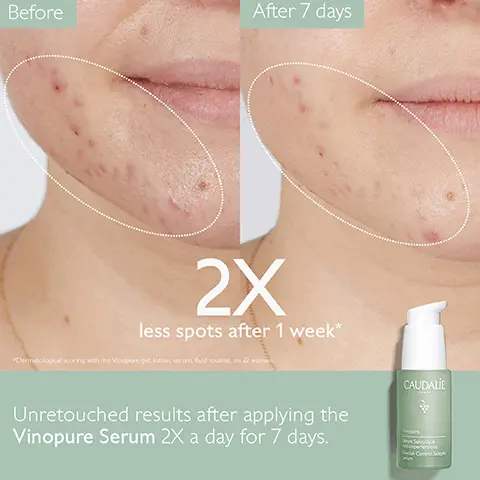 Image 1, Before After 7 days 2X less spots after 1 week* *Dermatological scoring with the Vinopure gel, lotion, serum fluid routine, on 22 wome Unretouched results after applying the Vinopure Serum 2X a day for 7 days. CAUDALIE Con Image 2, CAUDALIE Vinopure Visible results after 1 week 2X less spots* *Dermatological scoring with the Vinopure gel lotion serum, fluid routine, on 22 women Image 3, Before After 4 hours *Clinical study self-assessment, 22 volunteers. Spot less visible after 4 hours* Unretouched result after applying the Salicylic Spot Solution. Result in 4 hours. CAUDAL Image 4, CAUDALIE Dries out and reduces redness Spots less visible after 4 hours *Clinical study, self-assessment, 22 volunteers