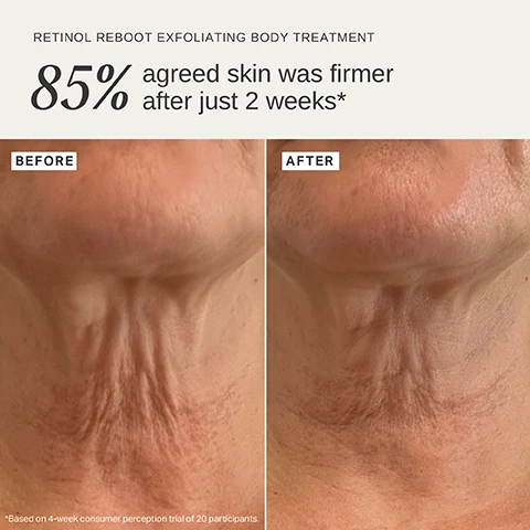 Image 1 - A before and after comparison shows a persons neck, with the before image displaying wrinkled skin and the after image showing visibly firmer and smoother skin, accompanied by the text RETINOL REBOOT EXFOLIATING BODY TREATMENT 85% agreed skin was firmer after just 2 weeks* *Based on 4-week consumer perception trial of 20 participants. Image 2 - The image features a tall green bottle of Alpha-H Retinol Reboot Exfoliating Body Treatment surrounded by light tan product swatches, with text detailing ALPHA-H RETINOL REBOOT EXFOLIATING BODY TREATMENT 120ml / 4.0 fl.oz, 1% ENCAPSULATED RETINOL Low irritation retinol accelerates skin renewal for firmer, smoother skin, 8% GLYCOLIC ACID Resurfaces to even tone + enhance luminosity, COQ10 Powerful antioxidant, stimulating cellular activity to promote reduced signs of ageing, and 2% LACTIC ACID Exfoliates dull skin + promotes ceramide production. Image 3 - A close-up of a persons neck and décolletage with white cream applied to the chest, featuring text overlays that say Firms skin, reduces redness, fine lines + wrinkles, and Smooths + evens.