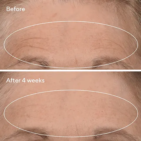 Before, After 4 weeks. Dramatically Lift + Firm. Serious results of retinoids without a doctor's visit. 01 Renewing Cleansing Cream, Cleanse with Renewing Cleansing Cream. Pat dry. 02 Retinal Resulpt Overnight Treatment, Apply a thin layer of Retinal ReSculpt Overnight Treatment to face + neck. 03 Retinol Youth Renewal Night Cream, At night, massage Retinol Youth Renewal Night Cream evenly over face, neck + chest. 04 Targeted Wrinkle Corrector, Tap into wrinkle with the metal side. If needed, use ring finger to tap into wrinkle. Let dry.