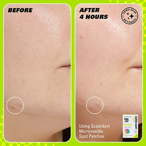 Image 1 - Side-by-side comparison of facial skin showing a blemish marked in a circle on the left labeled Before and the same area on the right labeled After 4 Hours with visible improvement, with text at the bottom stating Using Superdart Microneedle Spot Patches.
              Image 2 - Image shows a side-by-side comparison of two product packages for microneedle spot patches labeled Previous and New Packaging, with the previous package white and green, and the new one colorful with a modern design, featuring product information and the text WEVE HAD A GLOW UP! at the top and NEW LOOK. SAME INCREDIBLE FORMULA. at the bottom.