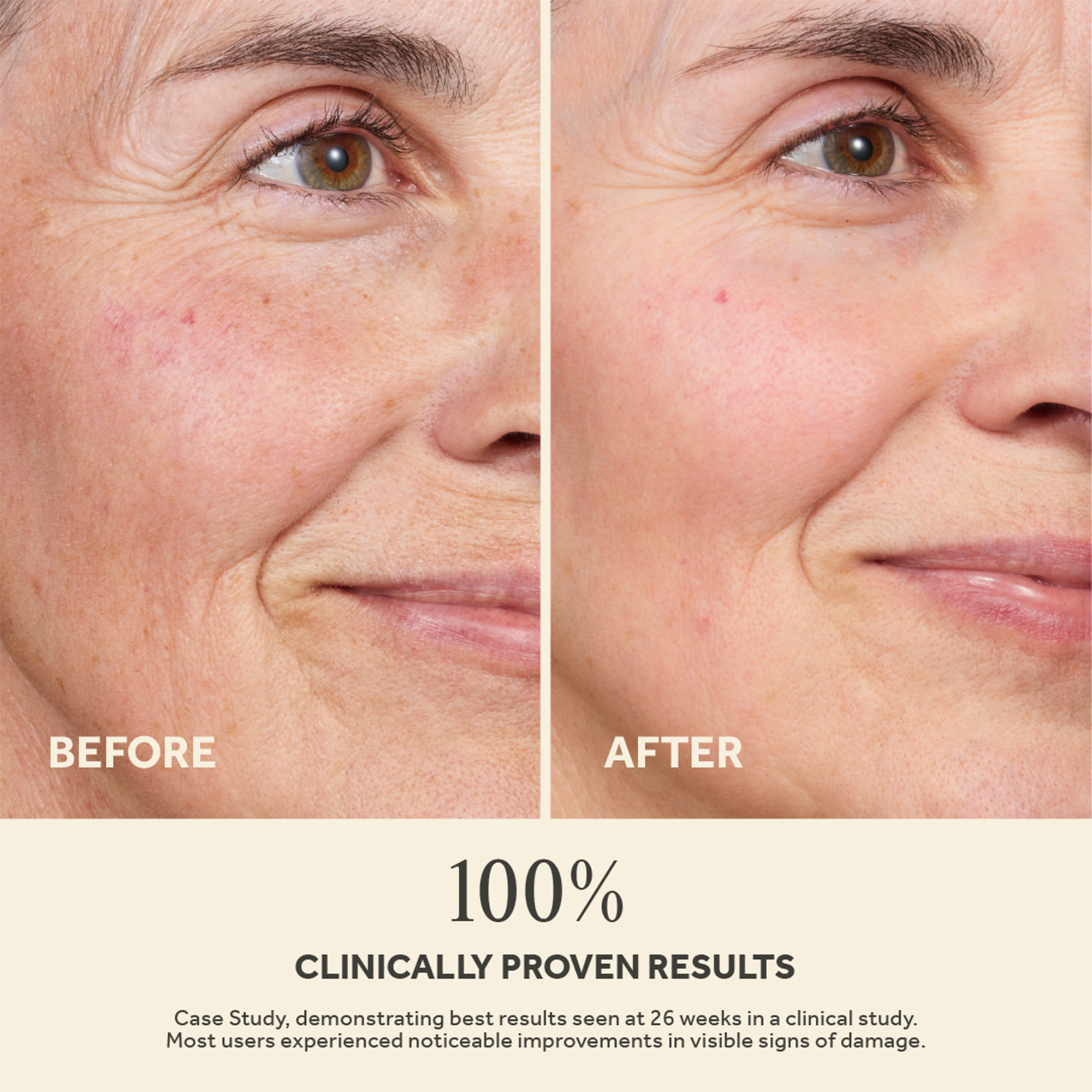 Side-by-side photos of a woman’s face labeled before and after, with smoother texture and fewer visible lines.