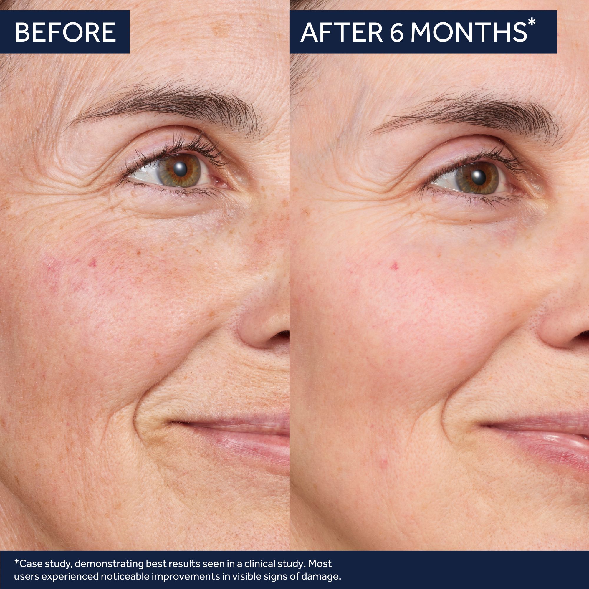 Image ProductMessage_1 - The image shows a silver bottle of No7 Future Renew Damage Reversal Night Serum on a blue surface, with text that reads Discover Future Renew Damage Reversal Night Serum Supercharged to reverse visible signs of skin damage while you sleep* and a button that says Discover More.