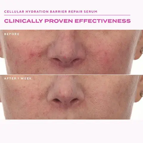 Image 1 - A before and after comparison of skin showing reduced redness and smoother appearance after 1 week, with the text CELLULAR HYDRATION BARRIER REPAIR SERUM CLINICALLY PROVEN EFFECTIVENESS BEFORE AFTER 1 WEEK. Image 2 - Before and after comparison image of a forehead showing wrinkles reduced after 2 weeks, with the text Retinol Youth Renewal Serum Clinically Proven Effectiveness Before After 2 Weeks. Image 3 - A split image shows a persons skin near the nose before and after treatment, with the top image showing more visible dark spots and uneven texture than the bottom image, alongside the text RAPID DARK SPOT CORRECTING SERUM CLINICALLY PROVEN EFFECTIVENESS BEFORE AFTER 2 WEEKS. Image 4 - A woman smiling shows her skin next to a bottle of Murad Retinol Youth Renewal Serum with text that reads CLINICALLY PROVEN EFFECTIVENESS Murad Retinol Youth Renewal Serum Sérum rajeunissant au rétinol RETINOL YOUTH RENEWAL SERUM SMOOTHS WRINKLES & BOOSTS RADIANCE IN 2 WEEKS *Proven results reported by trial participants in on 8-week clinical study. Image 5 - A woman smiles next to a bottle of Murad Cellular Hydration Repair Serum, with text reading CLINICALLY PROVEN EFFECTIVENESS, CELLULAR HYDRATION REPAIR SERUM, HYDRATES & REPAIRS SKIN BARRIER IN 30 MINUTES, Based on a 4-week clinical study with 47 participants, ranging in Fitzpatrick Types 1-6. Image 6 - A woman with serum on her cheek is shown next to a bottle of Murad Rapid Dark Spot Correcting Serum with the text CLINICALLY PROVEN EFFECTIVENESS RAPID DARK SPOT CORRECTING SERUM REDUCES THE LOOK OF DARK SPOTS IN 2 WEEKS *Clinically proven results via instrumental measurement of areas with dark spots. Murad Rapid Dark Spot Correcting Serum Sérum correcteur anti-taches pigmentaires à action rapide. Image 7 - A graphic explains how to use best selling serums with steps 1 Cleanse showing a tube icon, 2 Treat showing a bottle icon with text Apply serums evenly over face and neck, 3 Moisturise showing a jar icon, and a Tip section titled SKIN CYCLING with text Use Rapid Dark Spot Correcting Serum in the morning and Retinol Youth Renewal Serum at night On alternate days use Cellular Hydration Repair Serum both morning and night. Image 8 - A split image shows a womans face before and after two weeks of using a dark spot correcting serum, with the left side labeled BEFORE showing visible dark spots and the right side labeled AFTER 2 WEEKS* showing significantly faded dark spots and brighter skin, with additional text stating UNRETOUCHED CLINICAL RESULTS, VISIBLY BRIGHTENS*, 94 % noticed smoother and brighter skin*, and a footnote *Clinically proven results via instrumental measurement of areas with dark spots., alongside a Murad product bottle labeled Murad. Rapid Dark Spot Correcting Serum. Sérum correcteur anti-taches pigmentaires à action rapide. Image 9 - A before and after image displays a persons forehead and eyes, with the left side showing prominent wrinkles before treatment and the right side showing significantly smoother skin after 2 weeks, accompanied by a Murad Retinol Youth Renewal Serum bottle and text that reads BEFORE, AFTER 2 WEEKS*, UNRETOUCHED CLINICAL RESULTS, VISIBLY FIRMS SKIN*, 92% saw smoother skin in 2 weeks*, and *Clinically proven results via instrumental measurement of areas with dark spots. Image 10 - A split image shows a womans face with a Before view on the left displaying redness and an After 1 Week view on the right showing visibly reduced redness, with dotted lines highlighting areas of improvement, and an unretouched clinical results label, alongside text that reads Visibly Reduces Redness*, Repairs barrier in 30 minutes delivering hydration at the cellular level*, Based on a 4-week clinical study with 47 participants, ranging in Fitzpatrick Types 1-6, and a Murad Cellular Hydration Repair Serum bottle that says Sérum réparateur avec hydratation cellulaire.