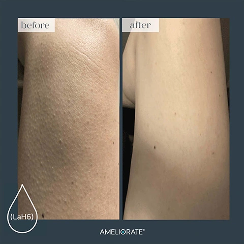 Image 2 - Image showing a side-by-side comparison of skin on an arm, with the left side labeled before showing rough texture and the right side labeled after displaying smooth skin, featuring the text (LaH6) and AMELIORATE at the bottom.