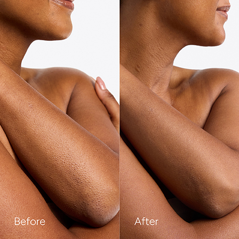 Image 4 - A split image showing a persons upper arm, elbow, and neck area with bumpy skin on the left and visibly smoother skin on the right, labeled Before and After.