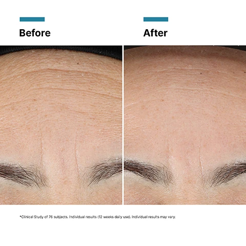 Image 1 - A before and after comparison image of a persons forehead, showing the left side with noticeable wrinkles and the right side with visibly smoother skin, with the text Before, After, and Clinical Study of 76 subjects. Individual results (12 weeks daily use). Individual results may vary. Image 2 - A split image shows skin before and after treatment, with the left side displaying multiple red, inflamed acne lesions and the right side showing significantly reduced redness and clearer skin texture, accompanied by the text Before, After, and Clinical Study of 76 subjects. Individual results (12 weeks daily use). Individual results may vary. Image 3 - The image shows a black SkinCeuticals Advanced RGN-6 pump bottle next to a swirl of peach-colored product in a petri dish, with text that reads: PROVEN RESULTS, -35% Damage Induced Pigmentation, +35% Smoothness, -18% Visible Wrinkles, -17% Visible Pores, Clinical Study of 76 subjects after 12 weeks, visual grading. Image 4 - A petri dish containing a light pink cream has lines pointing from it to a list of ingredients: KEY INGREDIENTS, 10% Glyco-Repair™, 1% Eperuline, 2% Niacinamide, 3% Acetyl Tetrapeptide-9, 0.2% Ectoin, 0.2% Bioceramide 603. Image 5 - Close-up of a persons dark skin with a light-colored cosmetic product smudge on the cheek, highlighted by a white circular graphic, with the text Improves the appearance of 6 key indicators of daily damage. Image 6 - An image displays a Complete The Morning Routine with four SkinCeuticals products: Step 1 Prevent C E Ferulic 30 ml / 1 fl oz serum, Step 2 Correct P-TIOX 30 ml / 1 fl oz serum, Step 3 Correct Advanced RGN-6 50 ml / 1.7 fl oz pump bottle, and Step 4 Protect Advanced Brightening UV Defense SPF 50 40 ml / 1.3 fl oz sunscreen tube. Image 7 - Four SkinCeuticals skincare products, including a tall blue pump bottle for cleansing, a small brown dropper bottle, a small dark grey dropper bottle, and a tall black pump bottle for treatment, are arranged left to right on a white background, visually outlining a complete four-step nighttime routine, with visible text: COMPLETE THE NIGHTTIME ROUTINE, STEP 1 CLEANSE Simply Clean SKINCEUTICALS SIMPLY CLEAN PORE-REFING GEL CLEANSER NORMAL TO OILY SKIN 200 ml / 6.7 fl oz CLEANSE, STEP 2 PREVENT C E Ferulic SKINCEUTICALS C E FERULIC HIGH POTENCY TRIPLE ANTIOXIDANT TREATMENT 1 fl oz / 30 ml PREVENT, STEP 3 CORRECT P-TIOX SKINCEUTICALS P-TIOX METALLIC ANTIOXIDATIVE PEPTIDE SERUM 30 ml / 1 fl oz CORRECT, STEP 4 CORRECT Advanced RGN-6 SKINCEUTICALS ADVANCED RGN-6 BIOMIMETIC RECOVERY COMPLEX 50 ml / 1.7 fl oz CORRECT.