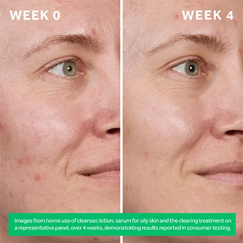 week 0, week 4. Images from home use of cleanser, lotion, serum for oily skin and the clearing treatment on a representative panel, over 4 weeks, demonstrating results reported in consumer testing. New REHAB FOR YOUR SKIN, LEARN MORE.