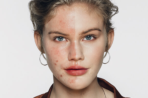 About Dermablend
